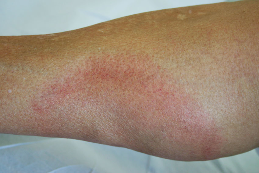lyme disease picture